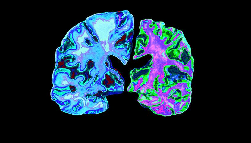 scans of brains with and without Alzheimers