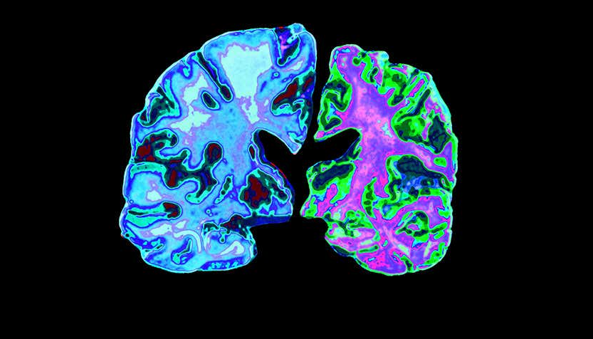 healthy brain and brain with Alzheimer's disease